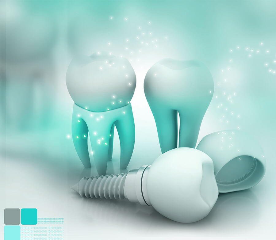 dental-implant